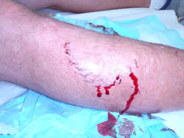 Shark bite